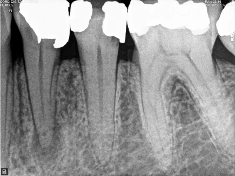 Radiografía periapical de muelas que ejemplifica las 10 ventajas de los rayos X para identificar alteraciones dentales con precisión.